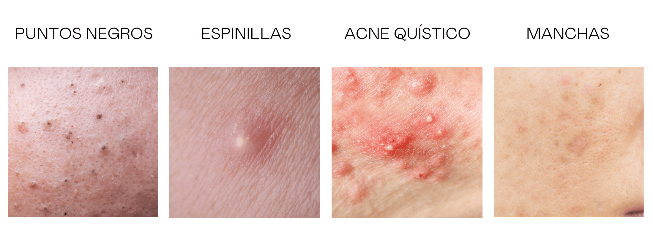 impurezas piel