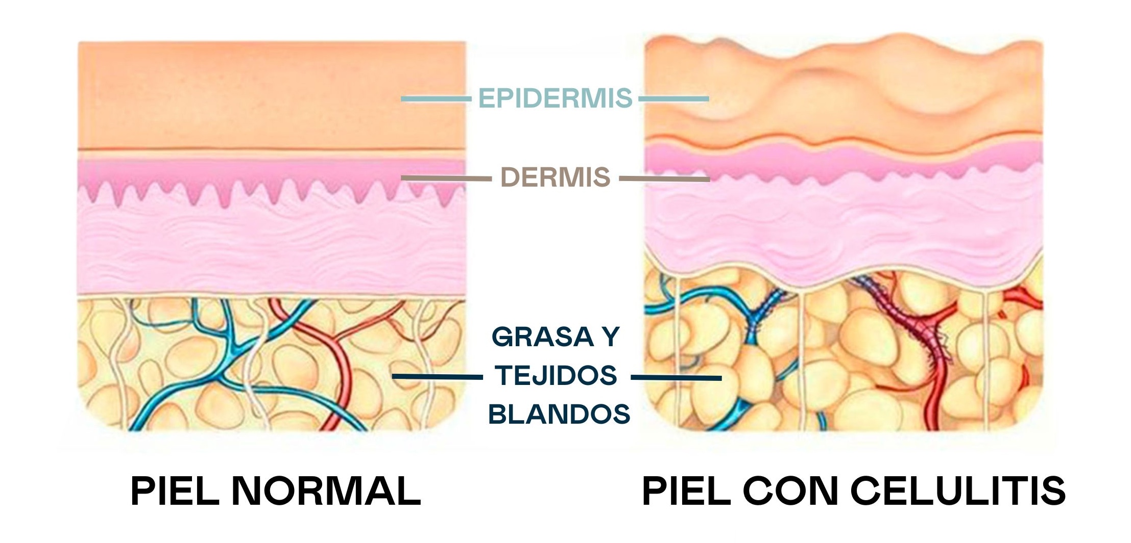 piel celulitis